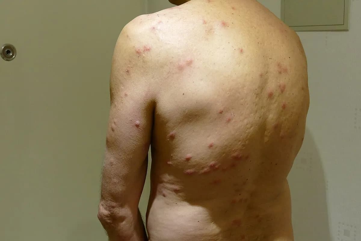 A man's back and upper arm covered with many small red bed bug bites, some in short lines and clusters, after a hotel stay